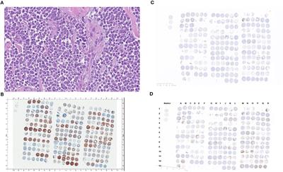 Association of Programmed Death 1 Protein Ligand (PD-L1) Expression With Prognosis in Merkel Cell Carcinoma